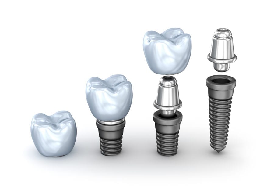 dental implant process in laurel md