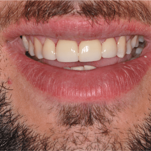 After dental care in Laurel Maryland by Laurel Smiles Dental Care