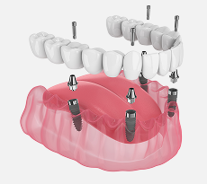 Multiple Dental Implants