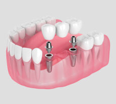 Dental Bridges