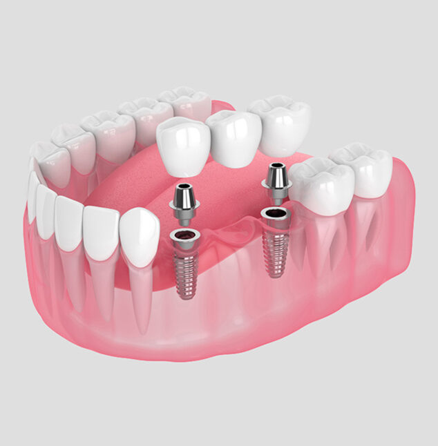 Dental Bridges