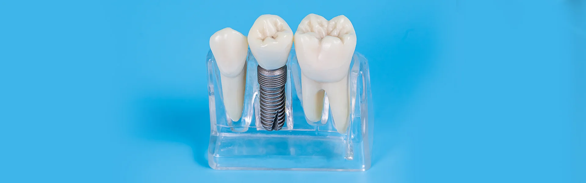 Advanced Tooth Replacement Solutions