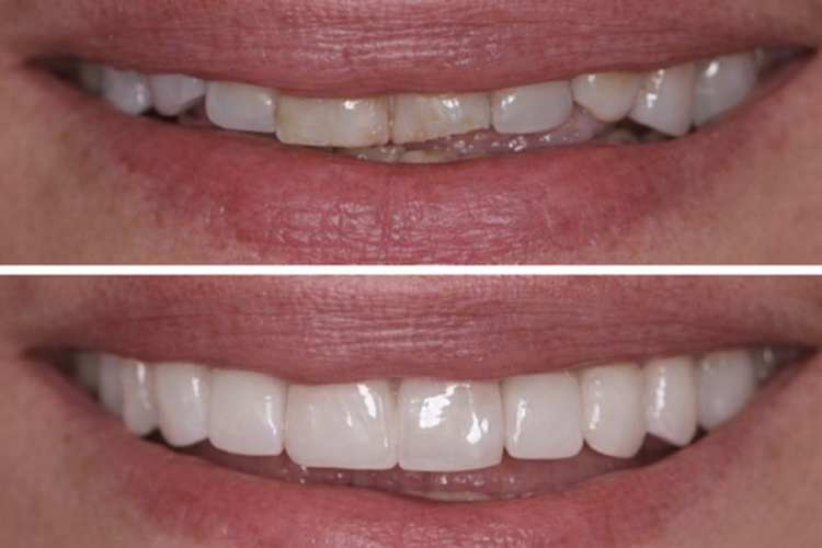 laurel smiles dental care