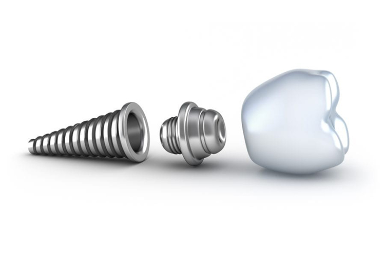 Implant Dentist Laurel