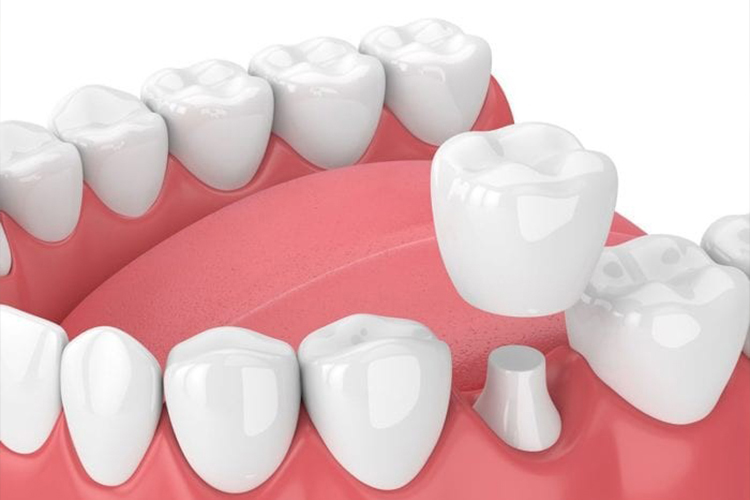 Dental Crowns in Laurel, MD