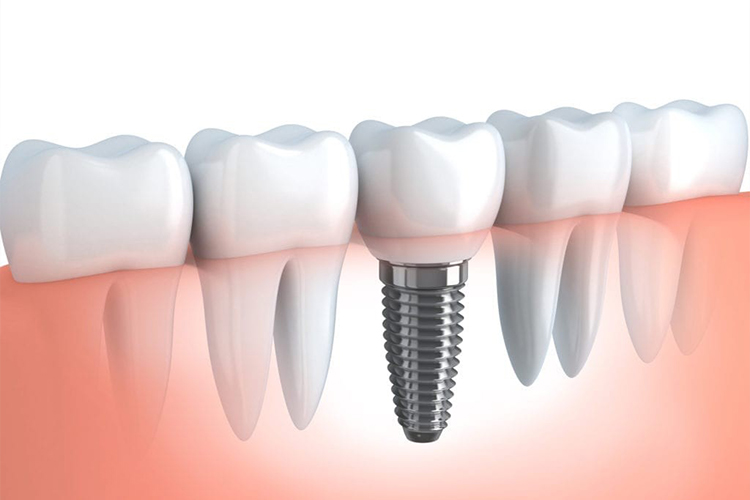 Single Dental Implant Laurel, MD