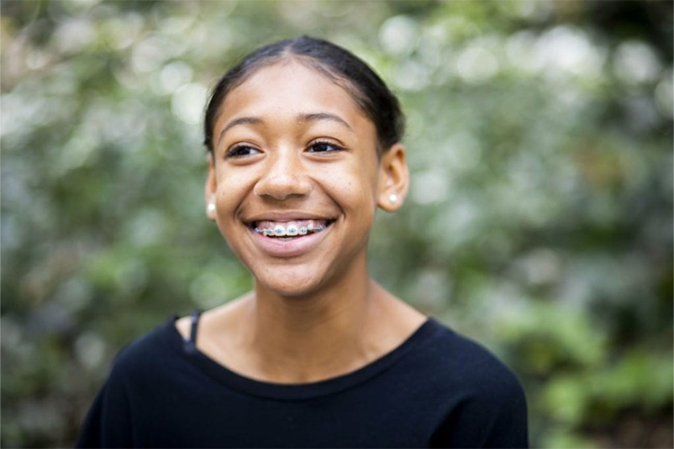 Straighter Smiles Without Braces