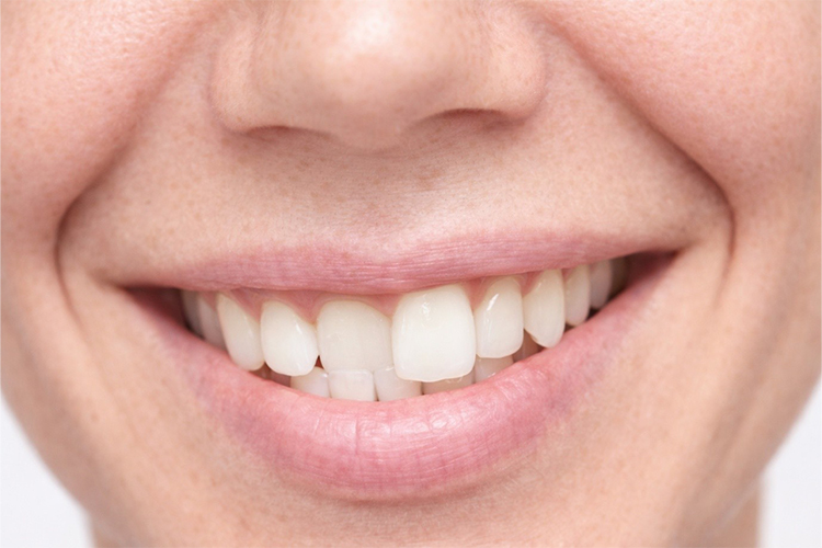 Tooth Bonding Services