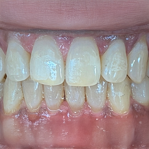 After dental care in Laurel Maryland by Laurel Smiles Dental Care