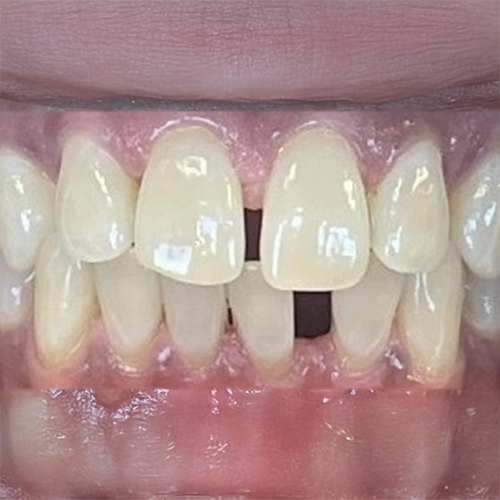 Before dental care in Laurel Maryland by Laurel Smiles Dental Care