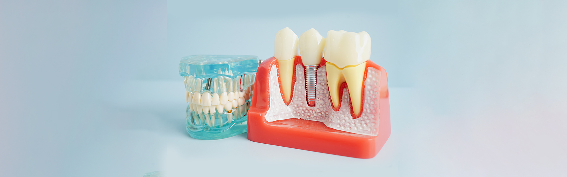Dental Implant