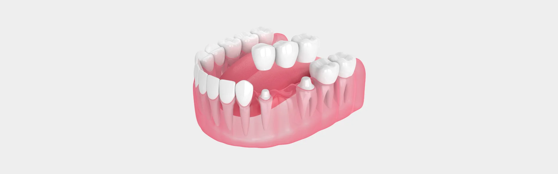 Dental Implant