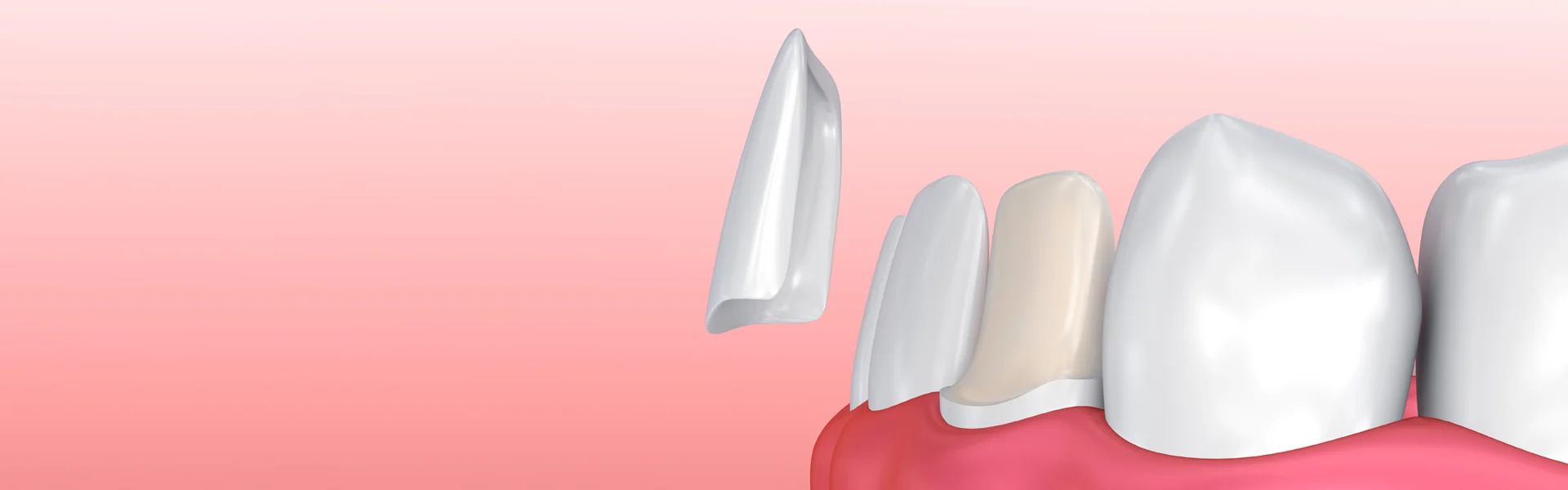 dental crowns